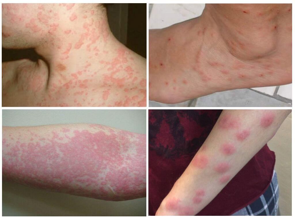 Зліва алергічне висипання на шкірі, праворуч - укуси клопів і алергія на них