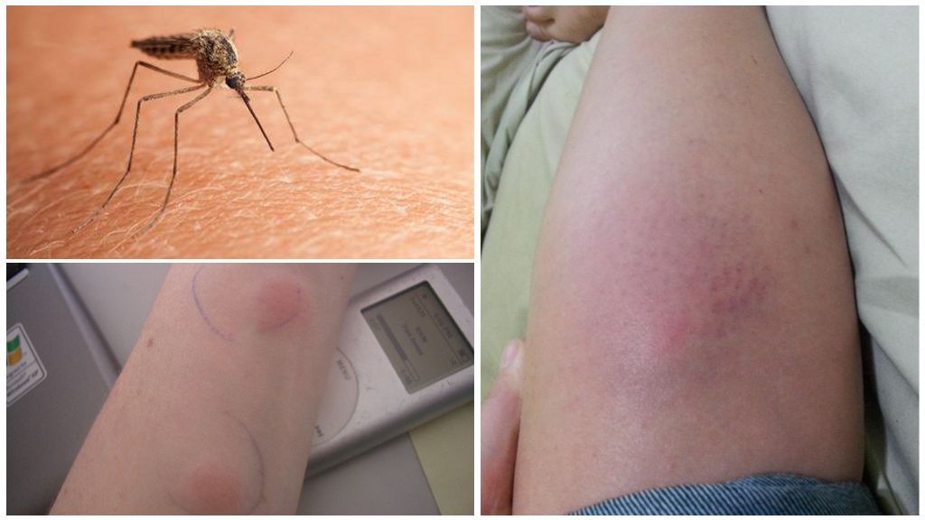 Синці від укусів комарів