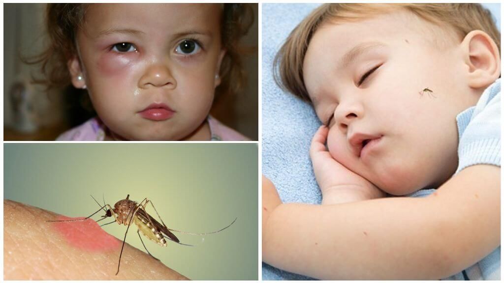 Опух очей у дитини від укусу комара