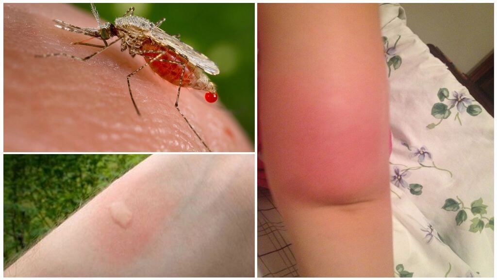 Алергія після укусу комара