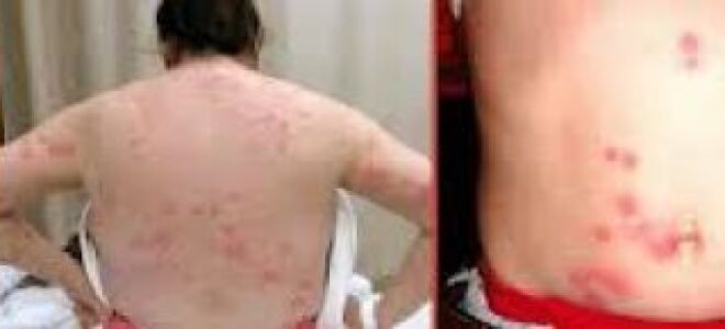 Як лікувати укуси клопів на тілі у людини, дитини? фото