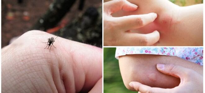 Через скільки часу проходять укуси комарів