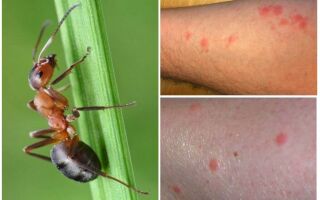 Укус мурашки – фото і опис ураження шкіри, ніж лікувати