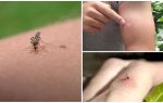 Що робити і як зняти пухлина і почервоніння від укусів комарів