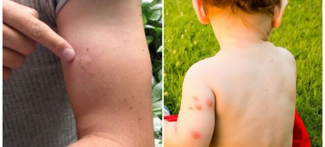 Покусали комарі, що робити, щоб укуси НЕ свербіли