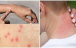 Опис і фото укусів комарів на шкірі у дітей і дорослих