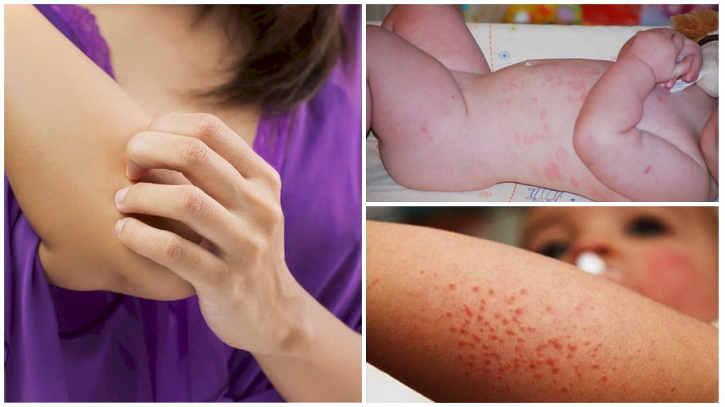 Алергія на засіб від комах