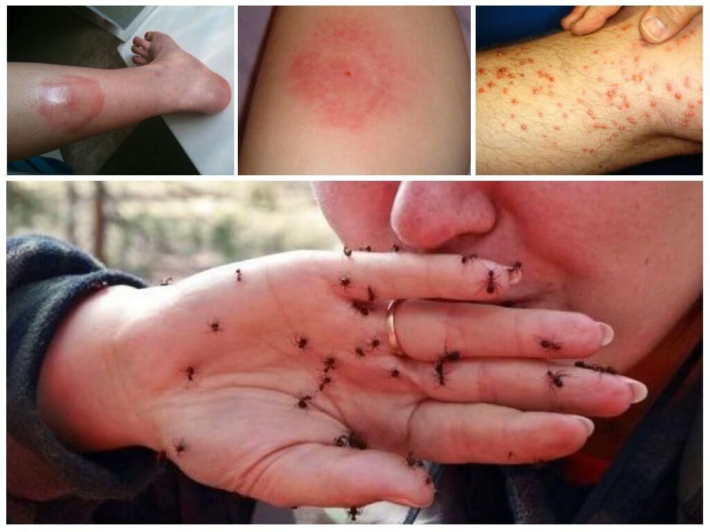 Алергічна реакція на укус мурашки