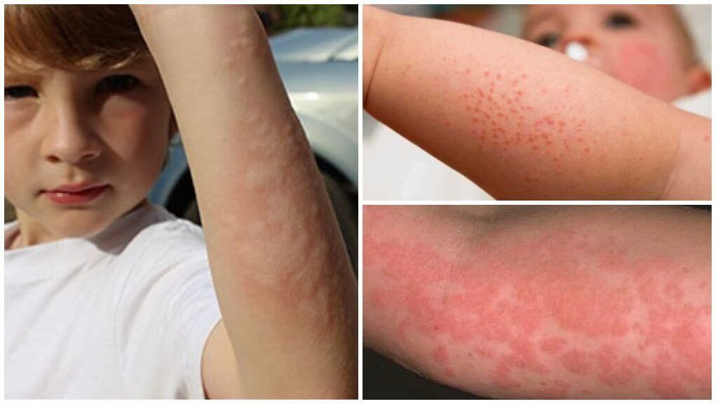 Зліва - опік кропивою, праворуч - кропив' /></p><p>Зліва – опік кропивою, праворуч – кропив’янка</p><p>Чи не кусається, але може залишати пухирі, подібні розчесаним укусів. При сильній алергії виникають великі пухирі, наповнені лімфатичної рідиною. Такі бульбашки ніколи не з’являються після нападу комах.</p><p>Комахи, кусаючи, впорскують отруту в щодо глибокі шари шкіри. Отрута поширюється під кожей.Лімфатіческіе бульбашки можуть виникати тільки при пошкодженні самого верхнього шару епідермісу. У цьому випадку верхній шар здувається, утворюючи «водяний» міхур.</p><p>На замітку!</p><p>Аналогічні бульбашки з’являються в результаті опіку ефірними речовинами, які виділяються купиною неопалимої.</p><h3>кропив’янка</h3><p>Масове висипання дрібних червоних папул на тілі не має ніякого відношення до будь-яких комах. Це реакція організму на інший алерген. У дітей до року кропив’янка часто з’являється при вживанні цитрусових або полуниці.</p><div style=